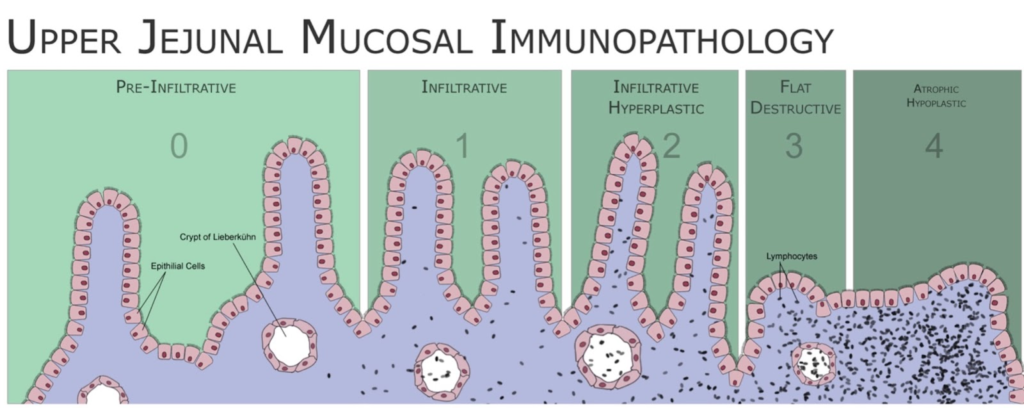 estudo sobre as condições da doença celíaca
